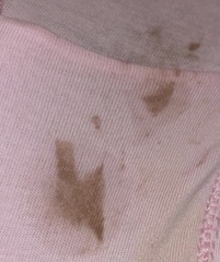 does this look like missed miscarriage?