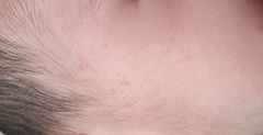 Spots on 6 month olds face