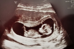 Any gender guessing experts!? 12 weeks 4 days