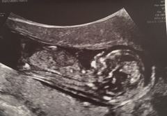 Nub theory guesses? Gender scan in 1 week