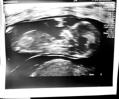 Nub theory 13 week scan