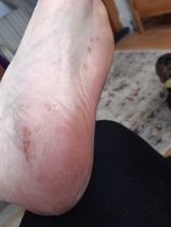 Could this be psoriasis on my feet?? Pics included.