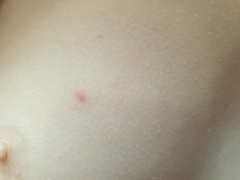 Does this look like Chickenpox again?