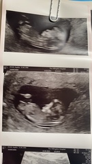 Gender 12 weeks