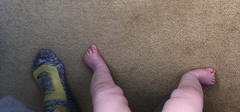 Baby’s foot turning out (pics)