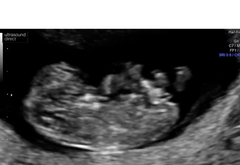 10 week scan - concern