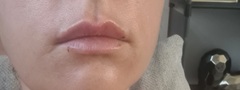 Just had my lips done