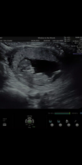 Gender guess 12 week scan
