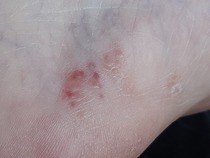 Could this be psoriasis on my feet?? Pics included.