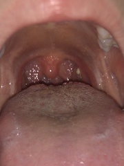 Tonsil stone klaxon!