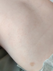 Three month old rash