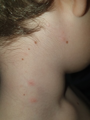 Does this look like Chickenpox again?