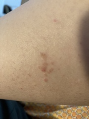 Worrying mole? Pic included