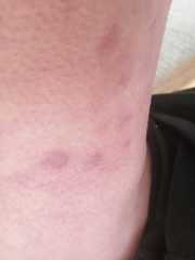 Weird rash / marks on upper thigh