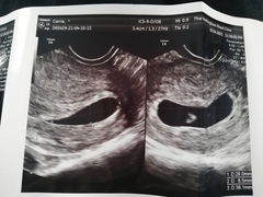 9 weeks since last period measuring 6mm crl no heartbeat