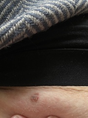 Raised sore mole?