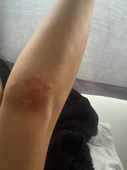 Any one with experience of gluten intolerance/ celiac?? Pics included please help x