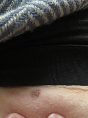 Raised sore mole?