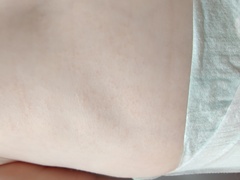 Three month old rash