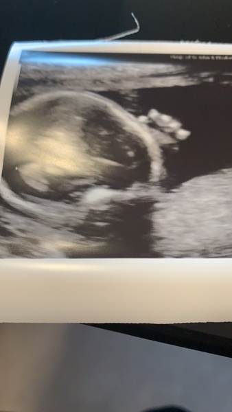 Pregnancy after loss - Autumn Babies 2021 - Thread 3