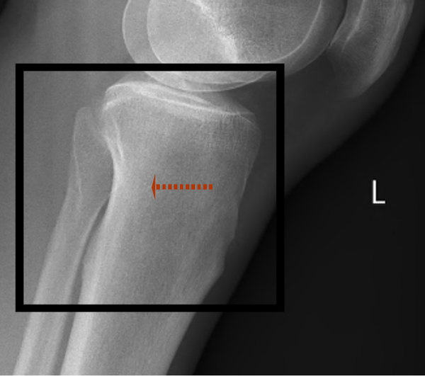 XRAY QUERY - ANY RADIOGRAPHERS OR KNEE EXPERTS ABOUT :)