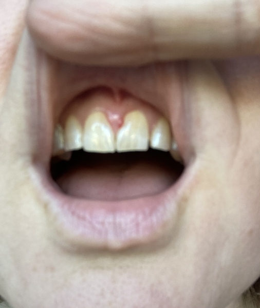 Any dentists around? What on earth is this on my gum? Worried.