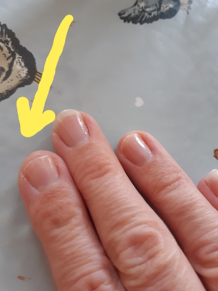 Nail issue