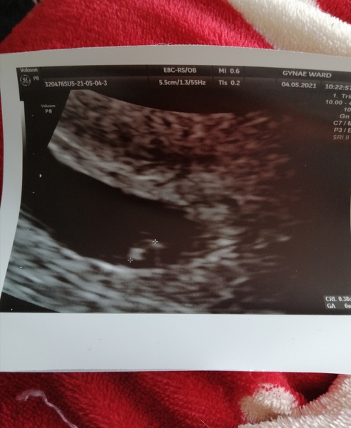 Endometriosis/TWW/pain