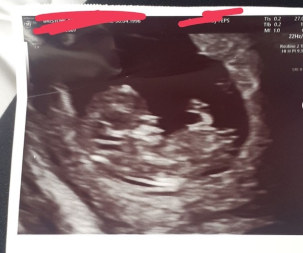 Baby scan boy or girl?
