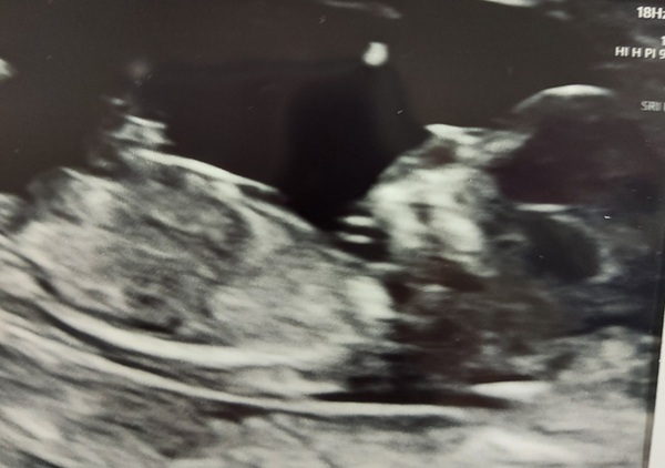 Nub guess,  13 weeks