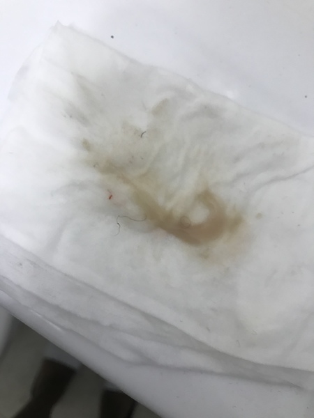 Bloody show, mucus plug or just discharge? *image warning*