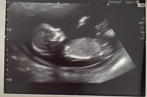 Boy or girl? 13w6 scan
