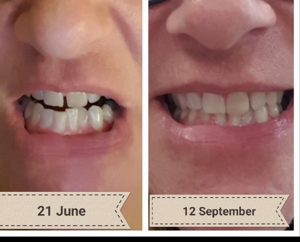 Invisalign