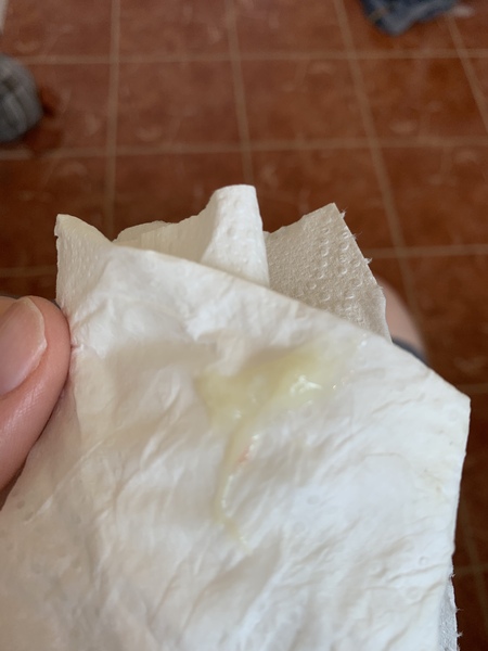 Sensitive Post. Mucus plug?