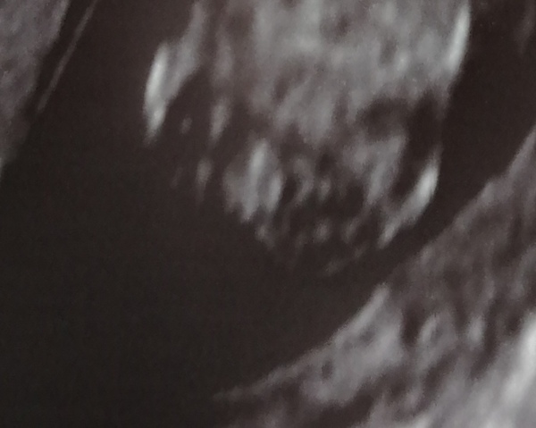 15w scan. Any guesses on sex?