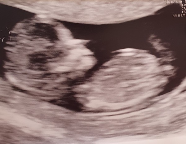 Gender guesses?? 12 week scan