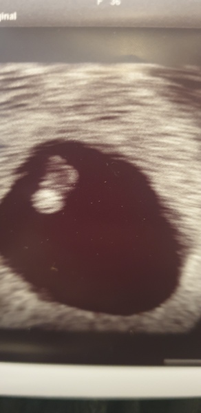 Pregnant after Blighted Ovum