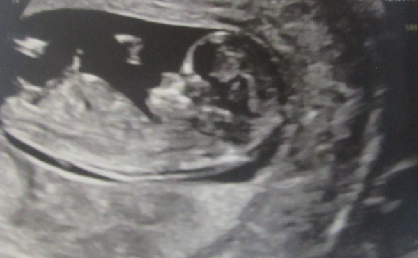 Do you want me to guess the sex? 12 week scans.
