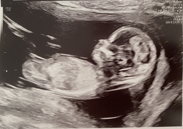 Boy or girl? Scan pic opinions please!