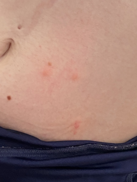 To ask for help about these bites