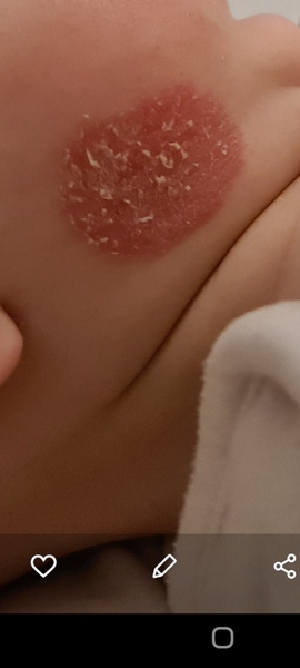 Eczema?!