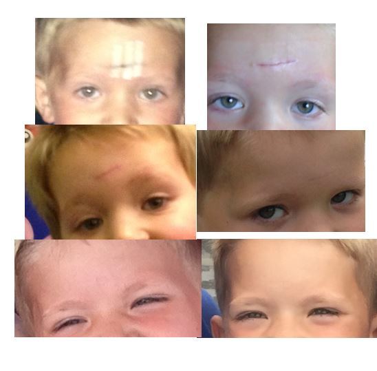 Help! Scar on my LO's face