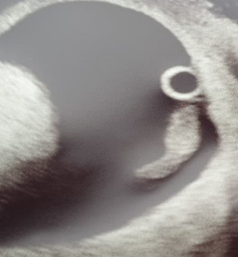 Brown Discharge at 5 weeks 4 days pregnant