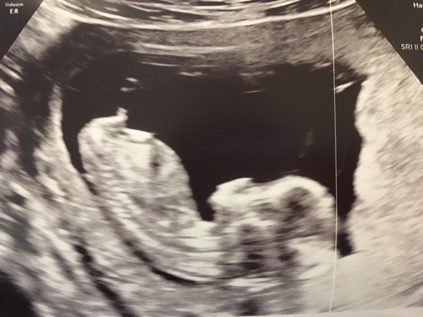 Anyone else at 12 weeks