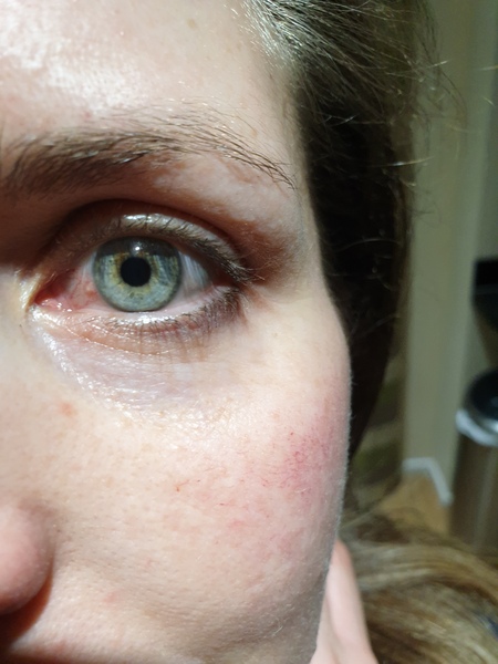 What is this on my eye? *photo