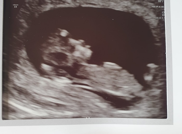 12 week scan guesses