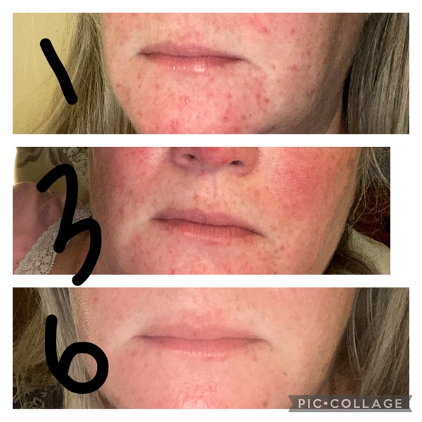 Soolantra - did you experience a dermodex die off?
