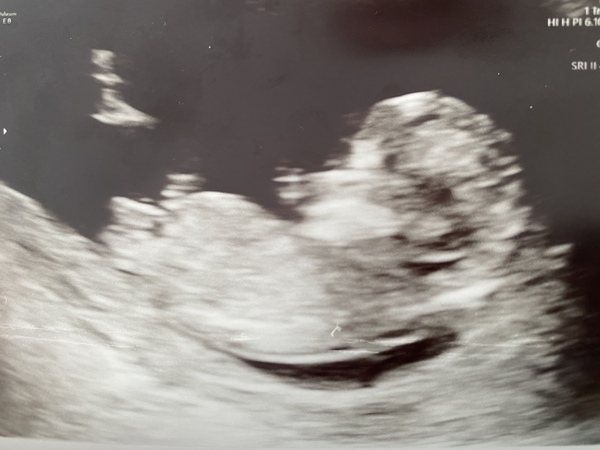 12 week scan gender