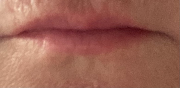Lip Fillers