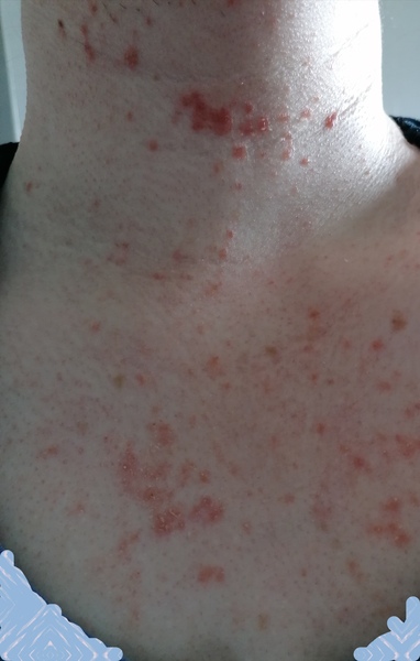 Any idea what this rash is?